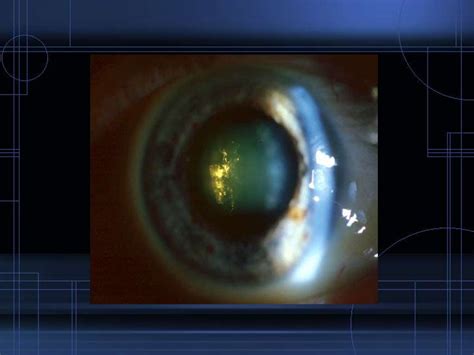 Complicated Cataract Online Presentation