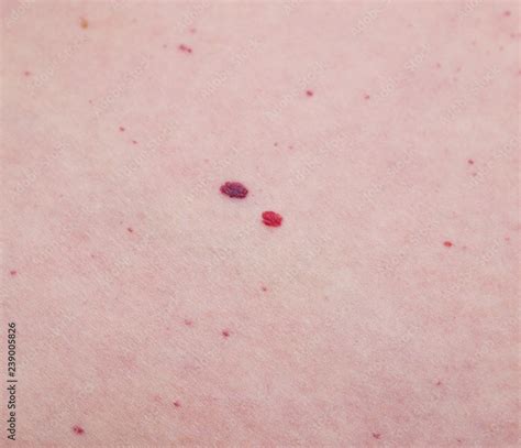 Hemangioma Microhematoma On Human Skin Close Up Disease Stock Photo