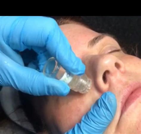 Dermaplaning Facial Dermaplane Facial Rr Skin And Laser Clinic