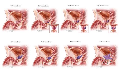 Like all cancers, prostate cancer begins when a mass of cells has grown out of control and begins invading prostate cancer staging is a method that indicates how far the cancer has spread in the body and is used to help determine the best treatment method. Prostate Cancer: Causes, Diagnosis & Treatment | Atlantic ...
