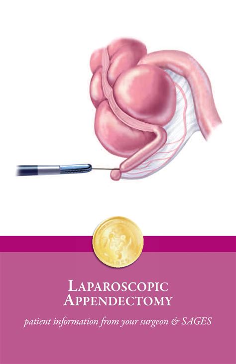 Laparoscopic Appendix Removal Appendectomy Surgery Patient Information