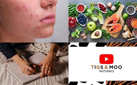 How To Treat Hormonal Adult Acne Naturally Tigs And Moo