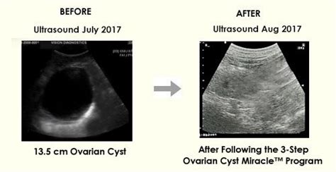 Ovarian Cyst Miracle Official Website Heal Ovarian Cysts And Pcos