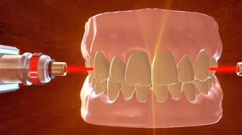 Could Laser Research Put An End To Dental Visits