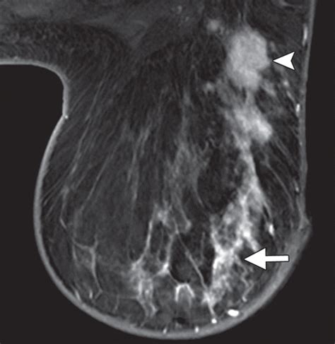 what radiologists need to know about diagnosis and treatment of inflammatory breast cancer a