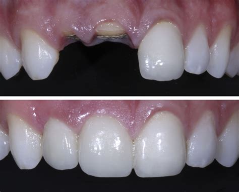 Root Canal Front Tooth Before And After