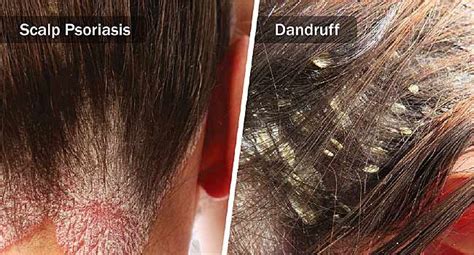 Webmd Explains The Differences Between Dandruff And Scalp Psoriasis Including Symptoms