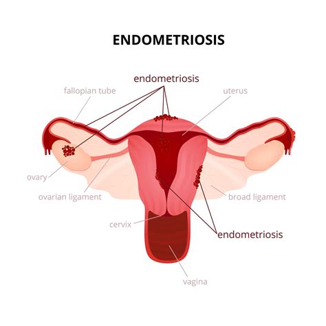 Endometriosis Symptomsdiagnosis Los Angeles Bakersfield Ca