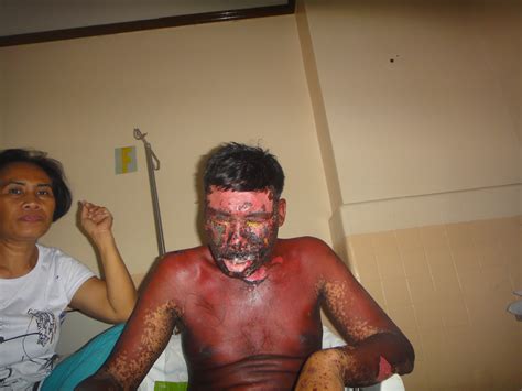 Group of the diseases called pigment hepatoses: Stevens-Johnson Syndrome: Stevens-Johnson Syndrome