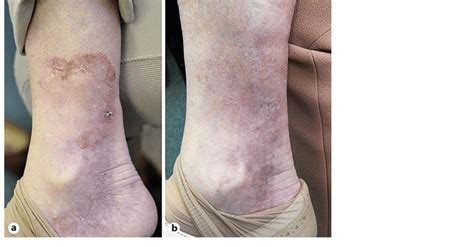 A Invasive Melanoma Of The Right Medial Lower Leg Before Treatment B