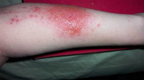 Poison Ivy Itchy Rash