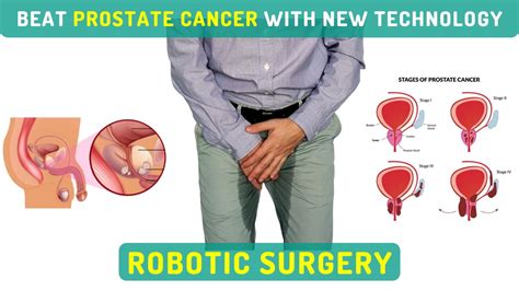 Benefits Of Getting Robotic Prostatectomy With Surgeons In India
