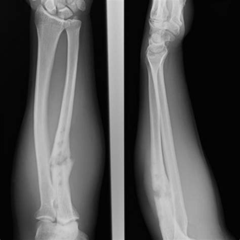 A Ap And B Lateral Radiographs Of Left Forearm In A 28 Year Old