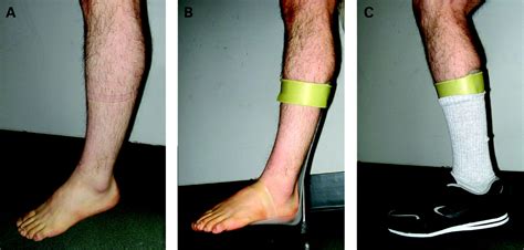 Foot Drop Where Why And What To Do Practical Neurology