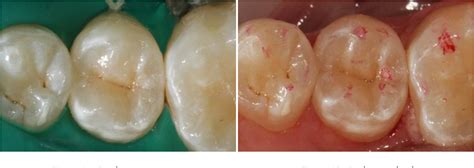 Figure 11 From Direct Posterior Composite Restorations Using Stamp
