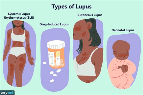 Lupus Symptoms Causes Diagnosis Treatment And Coping Types Of