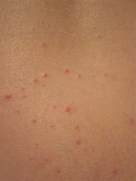 Back Acne Treatment You Can Get Rid Of Bacne Even If Its Cystic