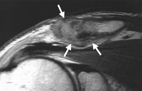 Mri Features Of The Acromioclavicular Joint That Predict Pain Relief