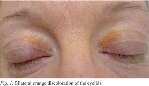 Bilateral Orange Discoloration Of The Upper Eyelids A Quiz Semantic