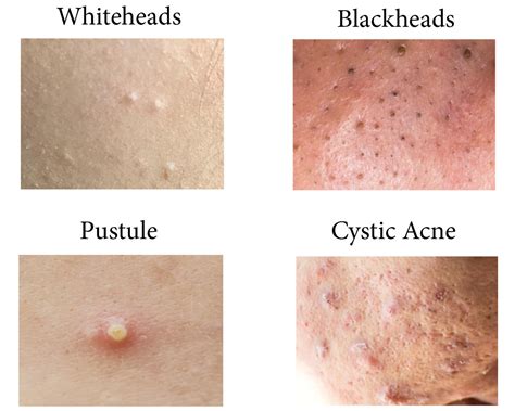 Dr Pimple Popper Reveals The Acne You Shouldnt Pop Readers Digest