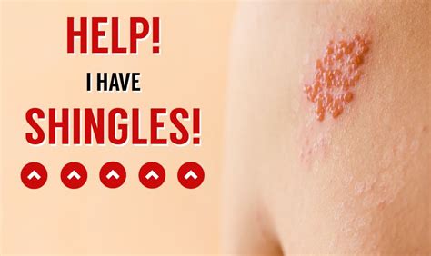 Help I Have Shingles Us Dermatology Partners Blog