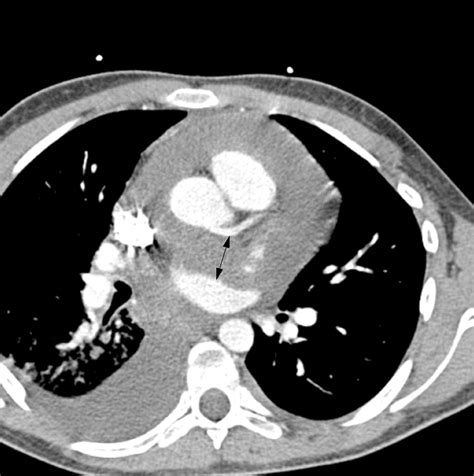 Primary Pericardial Mesothelioma Presenting As Pericardial Constriction