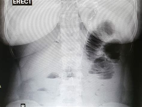 Internal Hernia After Single Anastomosis Sleeve Ilial Bypass Sasi