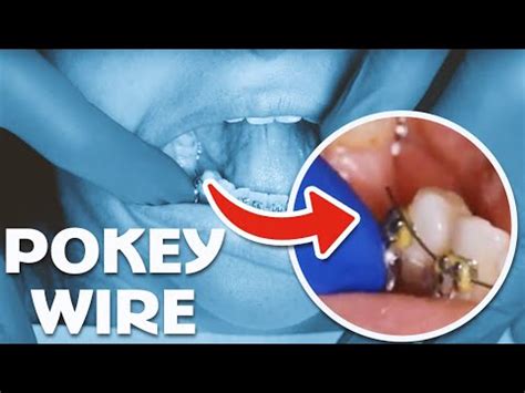 How To Cut Braces Wire In The Back At Home Joycenewton