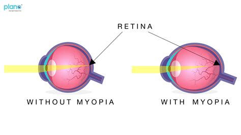 Myopia Nearsightedness Or Short Sightedness A Global Epidemic