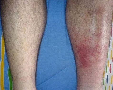 Cellulitis Symptoms In Legs