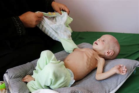 Children Are Starving In Yemen The White House Should Intervene The