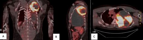 Figure From A Rare Case Of Pleuropulmonary Synovial Sarcoma Of The