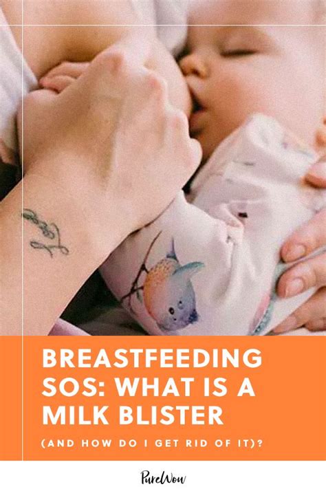 Breastfeeding Sos What Is A Milk Blister And How Do I Get Rid Of It