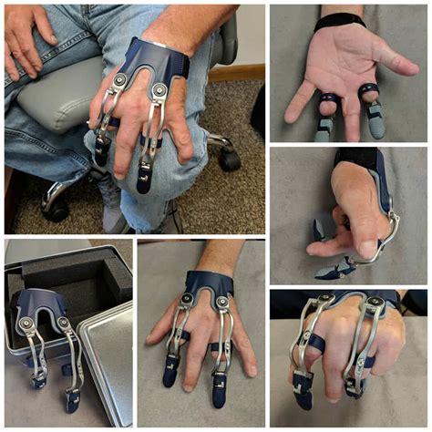 Finger Hand Photo Gallery Medical Art Prosthetics