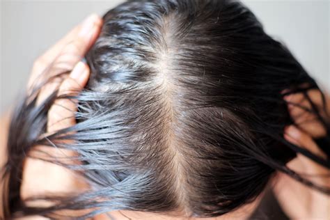 Menopause Hair Loss Symptoms Causes And Treatment