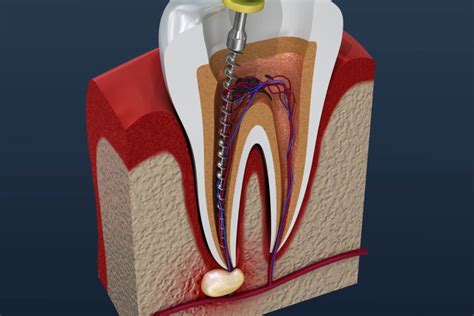 1.4 do i need a root canal or extraction? Think You May Need a Root Canal During COVID-19? Find Out ...