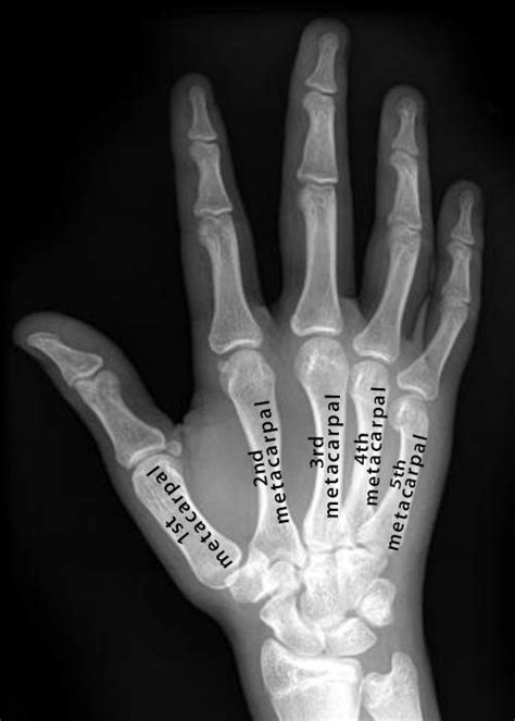 Hand Anatomy Bones