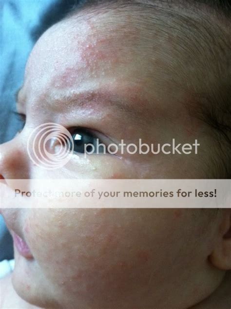 Rash Acne Or Cradle Cap On Face Help Ladies Pic Babycenter