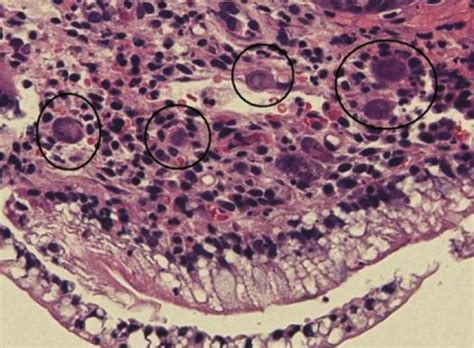 Microscopic picture of CMV inclusion bodies in donor duodenal biopsy