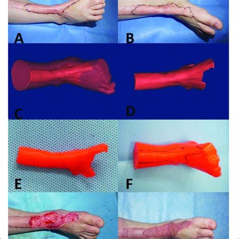 Measurements Of The Patient Scars And 3d Printed Models Download