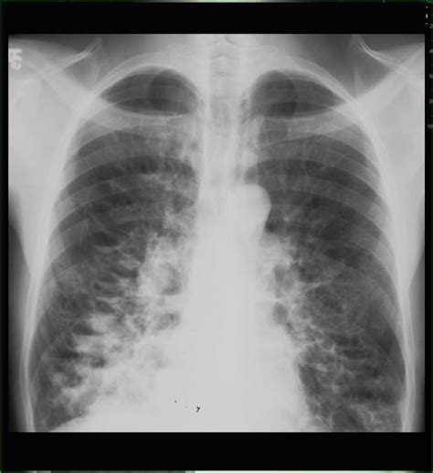 Bronchiectasis Chest X Ray