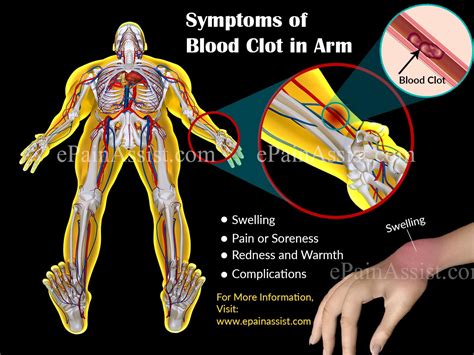 If a blood clot in the arm or leg is small enough, you may not have any symptoms. Blood Clot in Arm|Symptoms|Treatment|Home Remedies|Exercises
