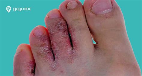 Athletes Foot Causes Symptoms And Treatments General Practice Private Doctors In Uk Gogodoc