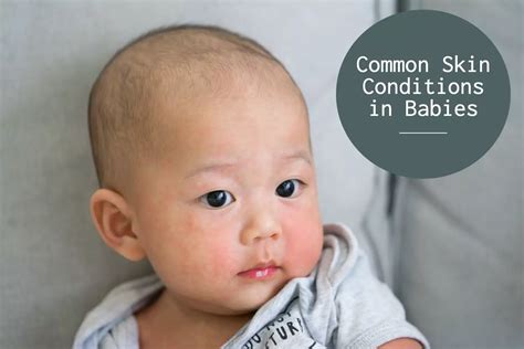 Common Skin Conditions In Babies Prevention And Remedies Being The