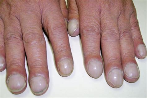 Finger Clubbing Symptoms Causes Diagnosis And Treatment