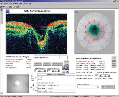 Oct In Glaucoma Diagnosis Detection And Screening Intechopen
