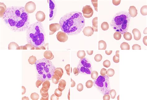 The Diversity Of Neutrophil Inclusion Bodies In Fulminant Sepsis Boyd