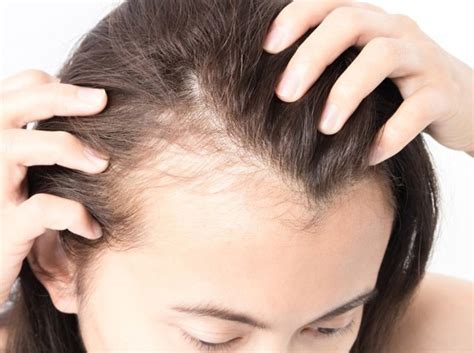 Androgenetic Alopecia Causes Symptoms And Treatment