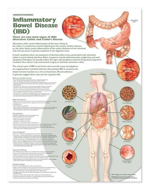 Inflammatory Bowel Disease Ibd Laminated Anatomical Chart Ph