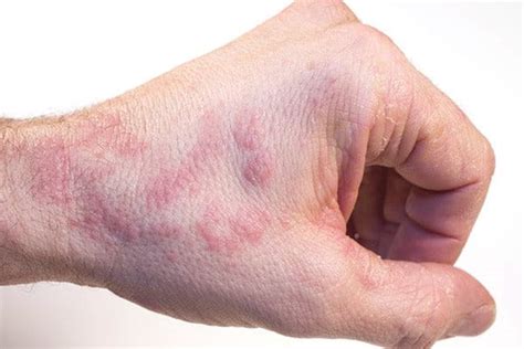 Dermatite Atopique Sur Les Mains La Comprendre Et La Traiter Eucerin